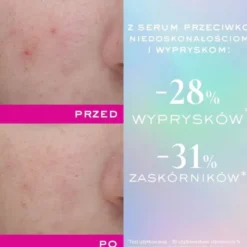 Nuxe Zinc Power, serum przeciw niedoskonałościom i wypryskom, 30 ml